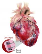 Experimental pacemaker that has no battery or wires