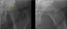 Figure 1. On plain radiography, a subchondral radiolucent line (arrows) was seen on internal rotation of the hip (A), and more clearly on external rotation (B) (arrows). 