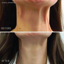 Before and after treatment of the platysmal bands with botulinum toxin