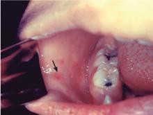 Figure 2. Koplik spots arise during the viral prodrome and are critical for the clinical diagnosis of measles before the onset of rash.