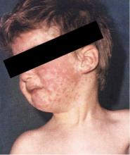 Figure 3. Morbilliform rash of measles.