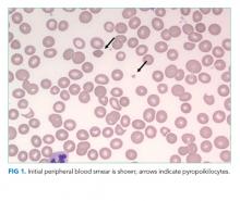 Initial peripheral blood smear is shown; arrows indicate pyropoikilocytes