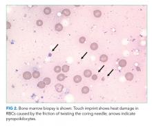 Bone marrow biopsy