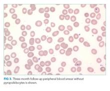 Three-month follow-up peripheral blood smear without pyropoikilocytes