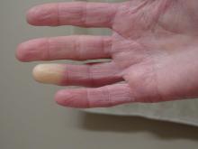 Raynaud's phenomenon on right hand