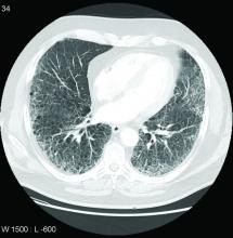 CT demonstrates extensive pulmonary fibrosis in the mid and lower zones (note the extensive honeycombing)