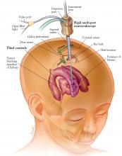 Figure 1. A purely endoscopic neurosurgical procedure.