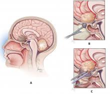 Figure 2. A: An anterior skull base meningioma of the planum sphenoidale to be resected with endo-scope-controlled microsurgery. 