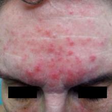 Papules and pustules in a patient with rosacea