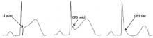 Figure 1. Early repolarization with and without QRS notch or slur.