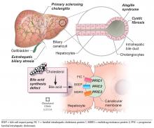 Cholestasis in children can be caused by biliary tract obstruction.