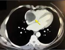 Figure 1. CT of the chest. An arrow points to the mass in the right atrium.