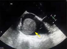 Figure 3. Transesophageal echocardiography.