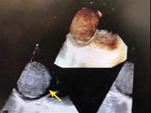 Figure 4. Transesophageal echocardiography.