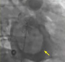 Figure 5. Angiography with pigtail catheter.