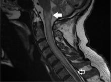 Figure 1. MRI of the cervical spine without contrast showed abnormal diffuse T2 hyperintensity beginning at the level of the medulla (solid arrow) and extending inferiorly to the level of C7 (open arrow).