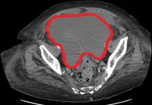 Figure 1. Abdominal computed tomography revealed a hematoma 15 cm × 15 cm within the paracolic gutter and pelvis, causing bladder compression and left-sided hydronephrosis.