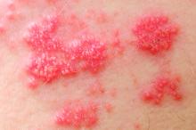Herpes zoster is a significant contributor to morbidity, disability and chronic pain.
