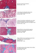 Findings on liver biopsy in nonalcoholic fatty liver disease and hepatitis C virus infection.