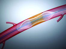 Illustration of a stent