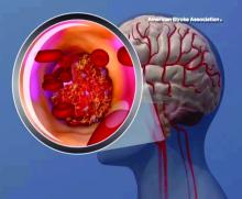 Graphic of a clot; ischemic stroke