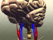 Illustration of stroke in the brain