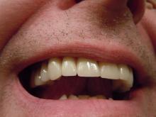closeup of upper teeth