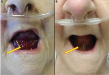 Figure 1. (A) After 48 hours of heparin infusion, the patient developed violaceous swelling at the floor of the oral cavity. (B) At 2 months after anticoagulation was stopped, the sublingual hematoma had completely resolved.