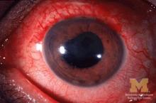 anterior uveitis is shown in this eye