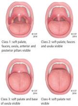 Figure 1. Friedman palate positions (classes 1, 2, 3, and 4).