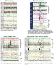 Figure 2. Polysomnogram excerpts with normal sleep, obstructive apnea, obstructive hypopnea, and respiratory event-related arousal waveform findings.