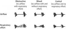 Figure 4. Apneas can be obstructive, mixed, or central.