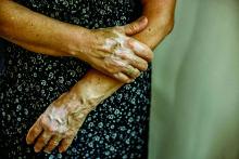 older woman with vitiligo on hands