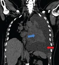 Coronal computed tomography shows left-sided pleural effusion (red arrow) and collapsed lung (blue ar-row), along with midline shift.