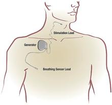 Figure 1. Hypoglossal nerve stimulation consists of an implanted pulse generator, sensing lead, and stimulation lead.