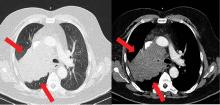 Computed tomography of the chest depicting biopsy-proven small-cell carcinoma 