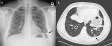 Figure 1. Chest radiography in the emergency department (A) showed a mild left-sided pleural reaction (arrow). Computed tomography (B) showed a mild pleural reaction (arrow) and parenchymal atelectatic and fibrotic changes.