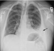 Figure 2. Chest radiography 5 days after the emergency department presentation showed development of a left-sided pleural effusion.