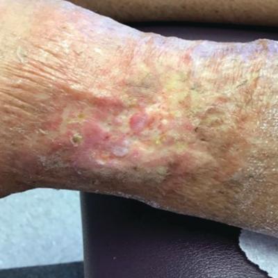 29 Year Old White Female with Grouped Blisters on Left Thigh