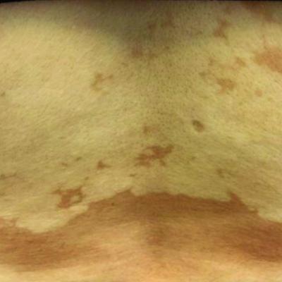 Asymptomatic hypopigmented macules and patches | MDedge Dermatology