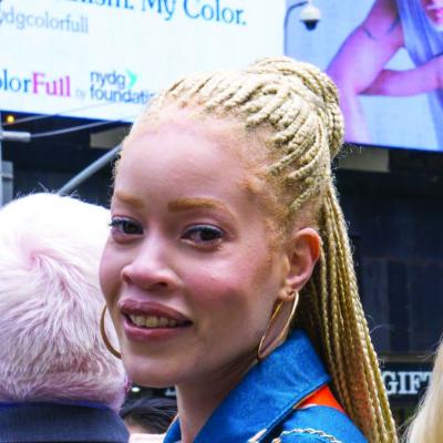 Albinism awareness goes global in dermatologists’ nonprofit work