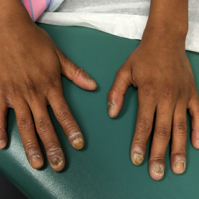Twenty Nail Dystrophy | Nails | Dr. Robert J. Schoenfeld | Wayne State  University SOM - Dermatology Image Atlas | WsuSom-Dermatology Image Atlas