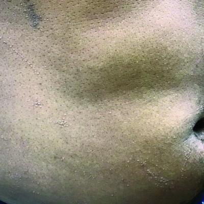 Flat-topped papules on the neck, arms, and trunk | MDedge Dermatology