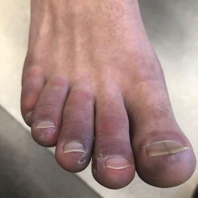 A 12-year-old male has persistent purple toes and new red lesions on