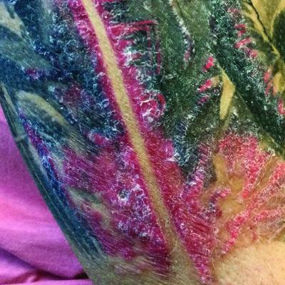 FAQ What is the White Frosting Caused by Laser Tattoo Removal  Andrea  Catton Laser Clinic