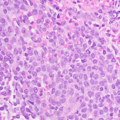 Rare hematologic malignancy may first present to a dermatologist ...