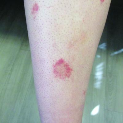 24-year-old female presents with a 3-month history of nonpruritic rash ...