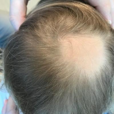 A toddler presents with patchy hair loss | MDedge Pediatrics
