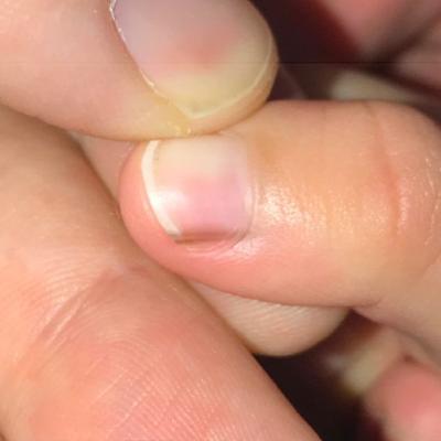 Vertical line on my fingernail | Mumsnet