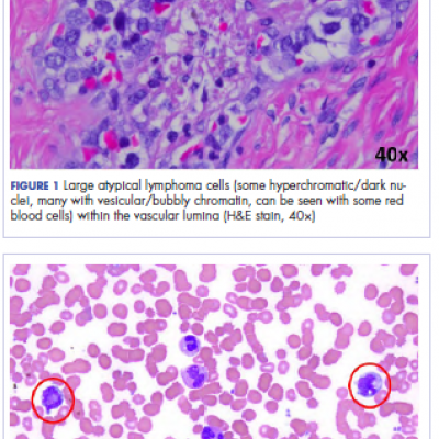 Intravascular Large B-cell Lymphoma: An Elusive Diagnosis With ...